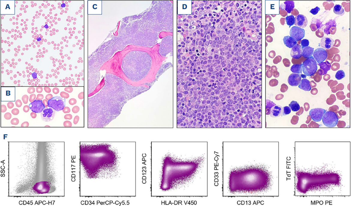 Myeloid blast phase of chronic myeloid leukemia with co occurring t1112p15q13NUP98HOXC12.jpeg